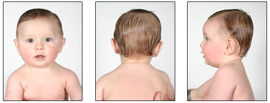 mild plagiocephaly