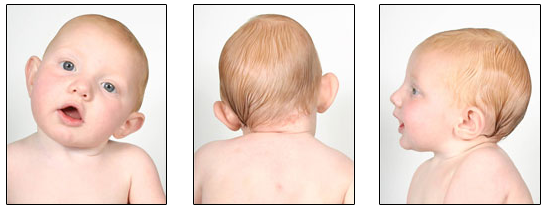 mild plagiocephaly