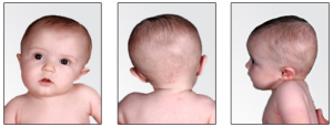 Torticollis/Plagiocephaly – Pediatric Therapy and Learning Center